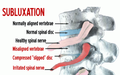 What is subluxation?